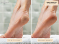 Super Grober Hornhautschleifer